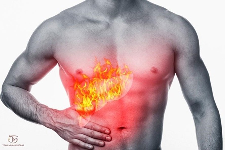 Hiện tượng nóng gan ở bệnh nhân (Ảnh minh họa)