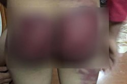 Người bố “suýt" bị khởi tố vì dùng roi đánh con gái bầm tím người