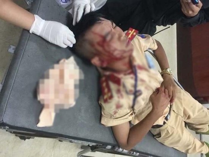 Đại &uacute;y Mai H&ugrave;ng Sơn - Đội CSGT số 7 - Ph&ograve;ng CSGT - CATP.H&agrave; Nội bị đối tượng n&eacute;m đ&aacute; chấn thương h&ocirc;m 26.7. Ảnh: PV