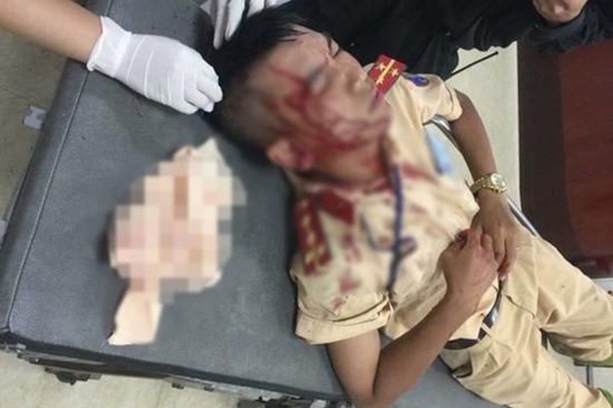 Đại úy Mai Hùng Sơn - Đội CSGT số 7 - Phòng CSGT - CATP.Hà Nội bị đối tượng ném đá chấn thương hôm 26.7. Ảnh: PV