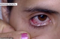 Nóng nhất hôm nay: Người phụ nữ đau đớn vì khóc ra "pha lê" mỗi ngày