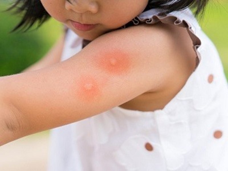 cách trị muỗi đốt cho bé