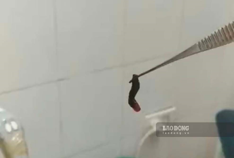 Quảng Ninh: Phát hiện vắt dài 2cm sống trong hốc mũi bệnh nhân
